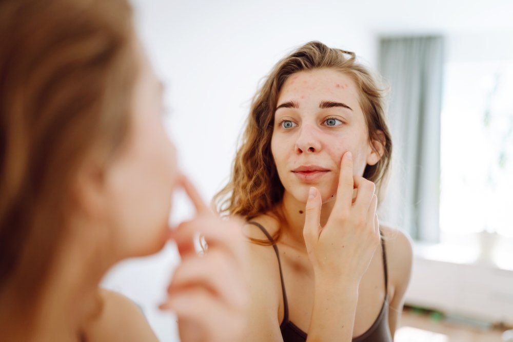 Pattanásokkal küzdesz? Ezek a gyógynövények segíthetnek